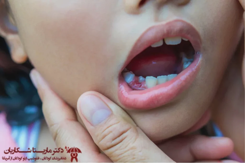 معاینه دندان شیری کودک