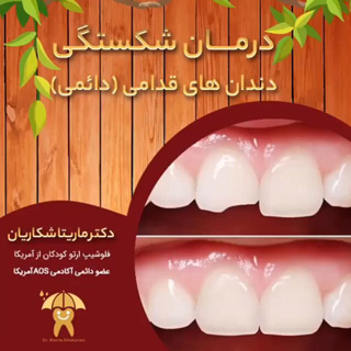 درمان-شکستگی-دندان-قدامی