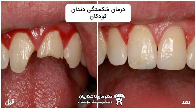 درمان شکستگی دندان کودکان