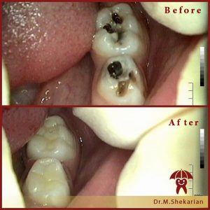 عصب کشی و ترمیم دندان توسط دکتر ماریتا شکاریان
