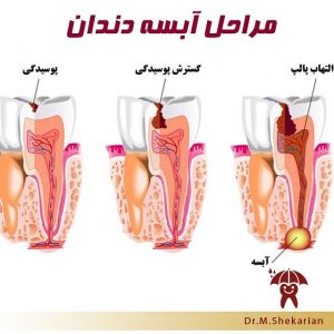 چه زمان نیاز به ترمیم دندان کودکان است