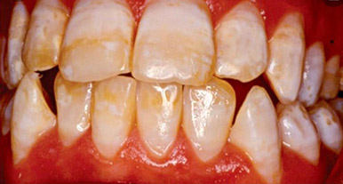 فلوروزیس خفیف