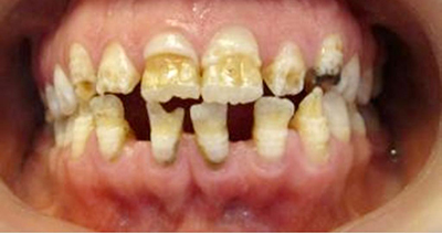 فلوروزیس شدید