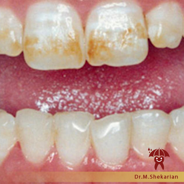 فلوروزیس متوسط در دندانهای قدامی