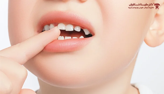 علت کج درآمدن دندان شیری