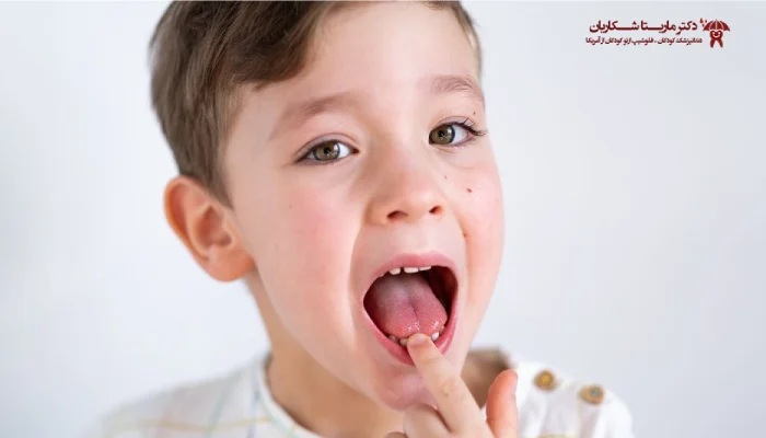 کج شدن دندان شیری