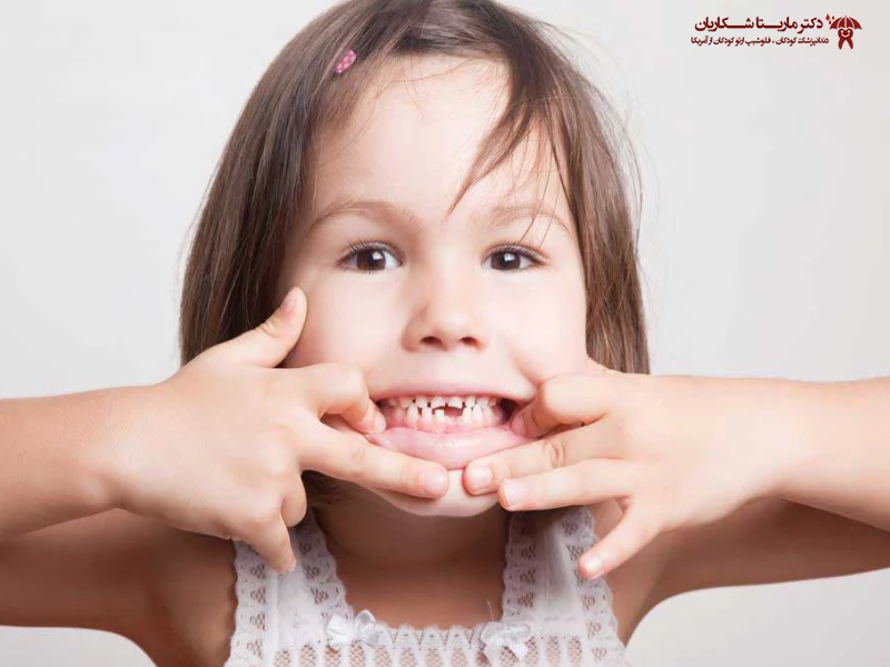 کج درآمدن دندان شیری