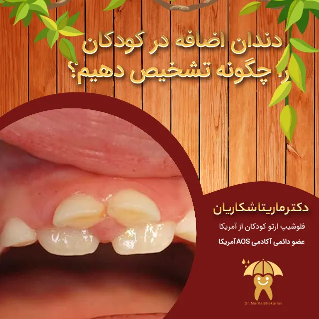 دندان اضافه در کودکان