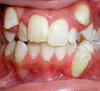 دندان های اضافی در کودکان