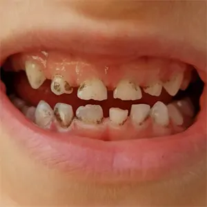 قطره اهن و سیاهی دندان