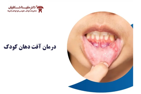 راه های درمان آفت دهان کودک