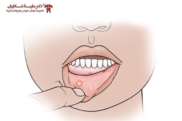 نکات مهم در درمان آفت دهان کودک