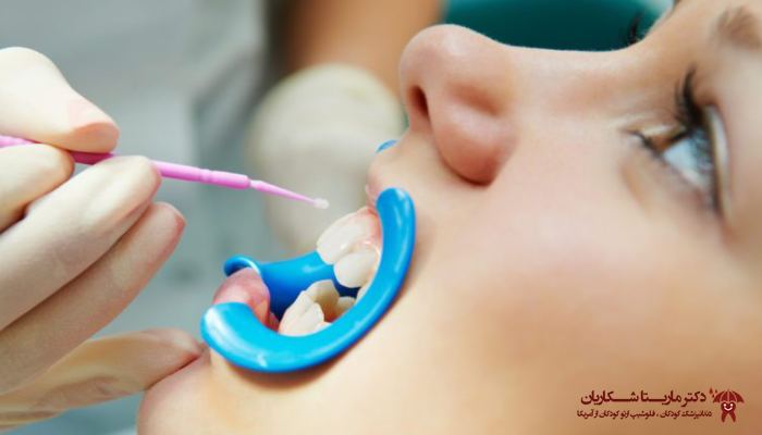 فلوراید تراپی در کودکان