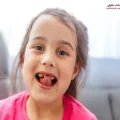 دیر افتادن دندان شیری