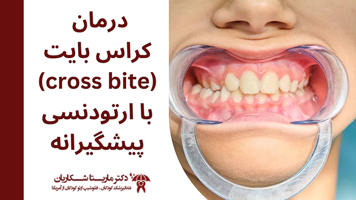 درمان کراس بایت با ارتودنسی پیشگیری