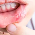 آفت دهان کودک