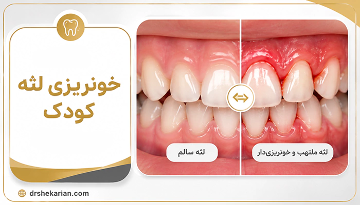 خونریزی لثه کودک